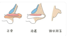 關(guān)于做包皮手術(shù)的費(fèi)用分析，包皮手術(shù)費(fèi)用詳解