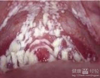 如何治療包皮龜頭炎，包皮龜頭炎的有效治療方法與步驟