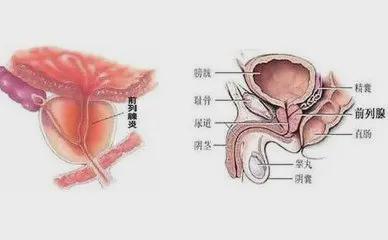前列腺炎會伴隨一生嗎？解析前列腺炎的真相與防治策略，解析前列腺炎真相，防治策略與避免伴隨一生的風(fēng)險