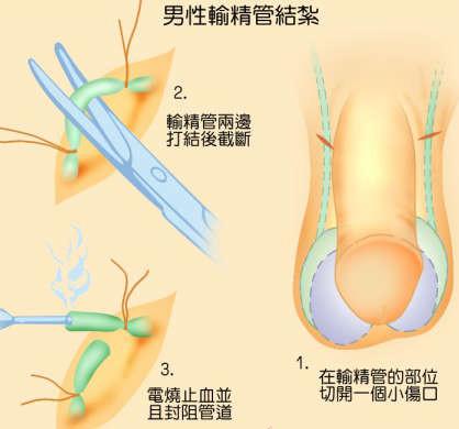 為什么醫(yī)院不提倡男性結(jié)扎，探究背后的原因與考量，探究醫(yī)院不提倡男性結(jié)扎的背后原因與考量