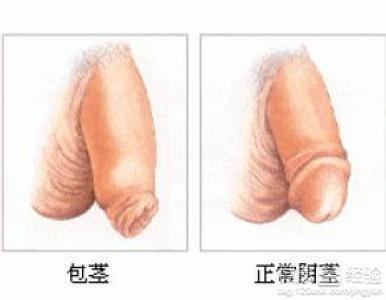 包莖過(guò)長(zhǎng)對(duì)身體的影響及應(yīng)對(duì)措施，包莖過(guò)長(zhǎng)對(duì)身體的影響與應(yīng)對(duì)措施解析