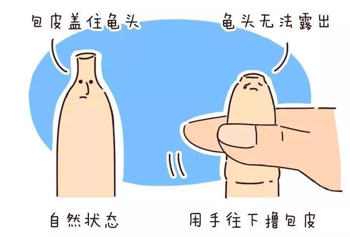 假性包皮過長需要割嗎？——深入了解與科學決策，假性包皮過長是否需要割？全面解析與明智決策